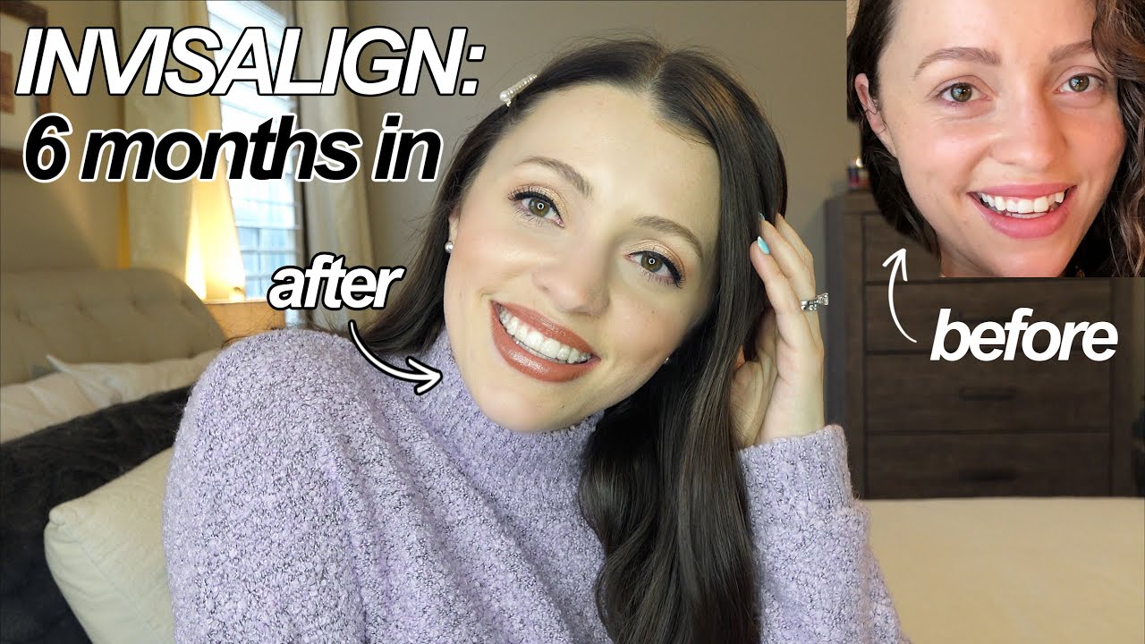 Invisalign Before And After 6 Months: Stunning Transformations